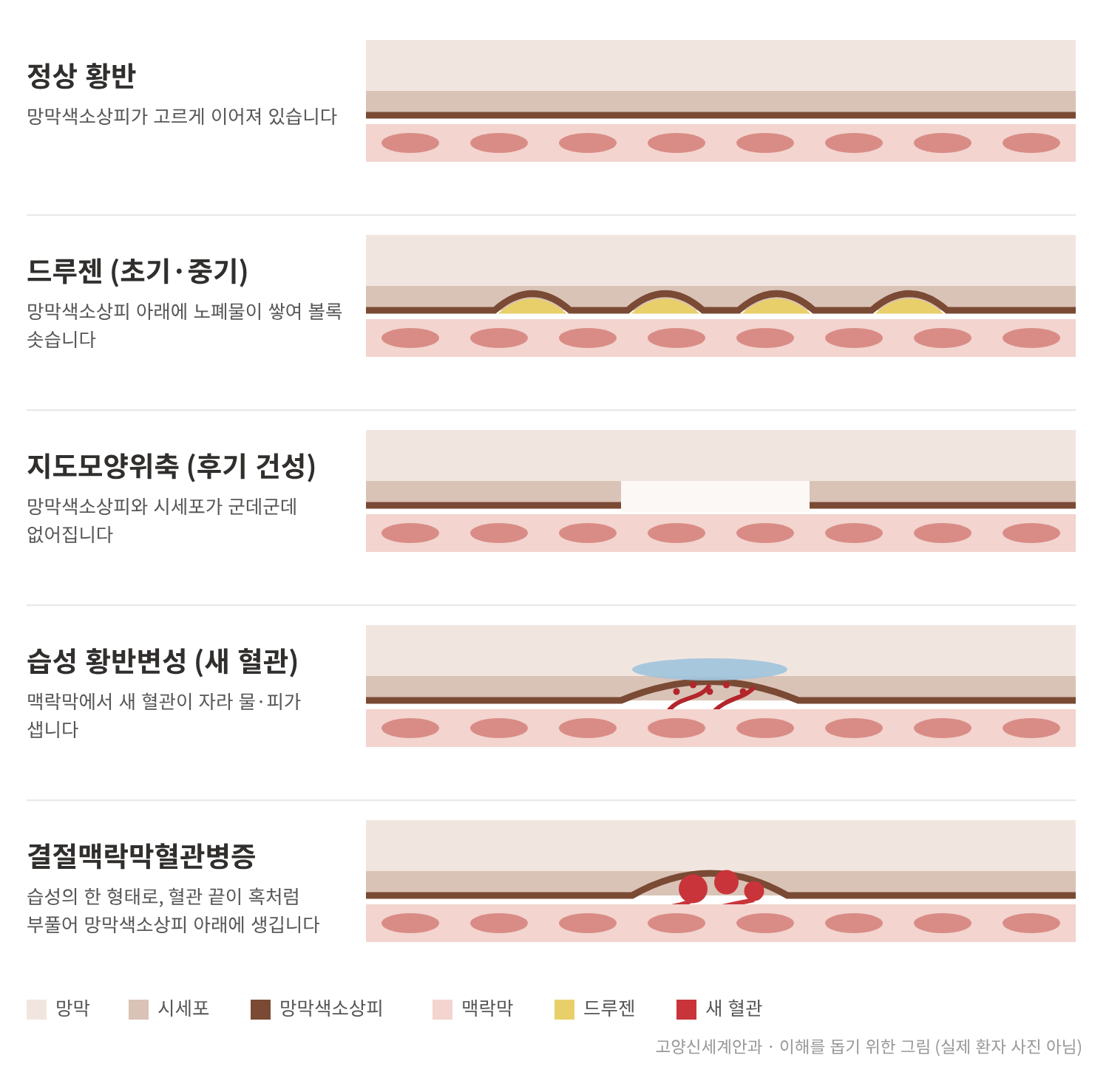 황반 단면 그림 - 정상, 드루젠, 지도모양위축, 습성 황반변성, 결절맥락막혈관병증