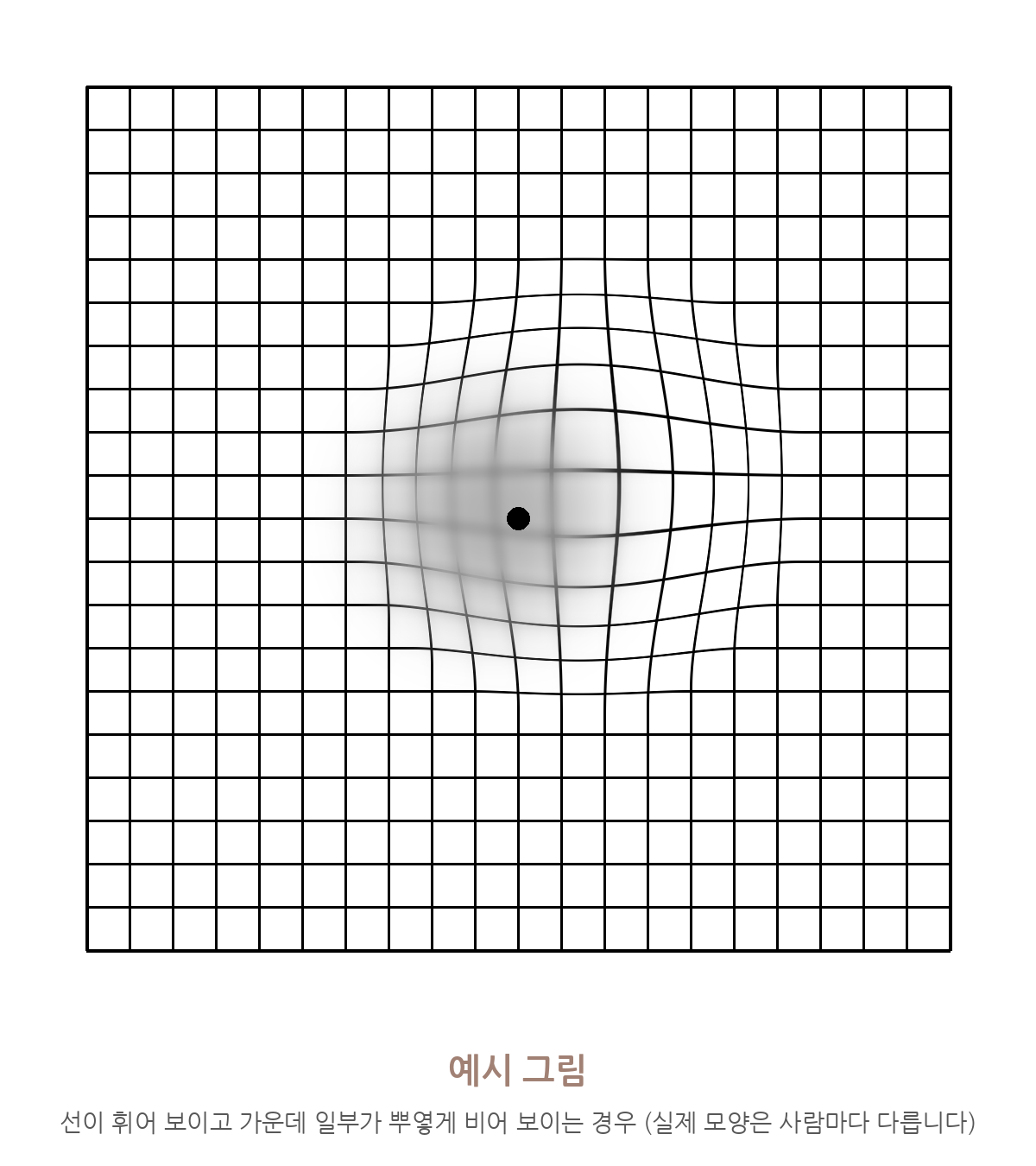 암슬러 격자가 휘고 가운데가 뿌옇게 보이는 예시 그림