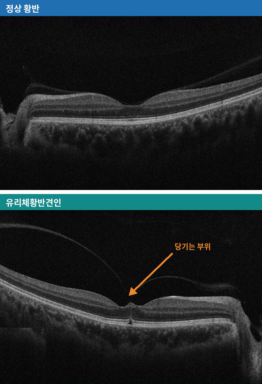 위 : 정상인 왼쪽 눈 황반, 아래 : 유리체황반견인이 있는 오른쪽 눈. 주황 화살표가 유리체 뒷면이 황반 가운데를 당기는 부위입니다