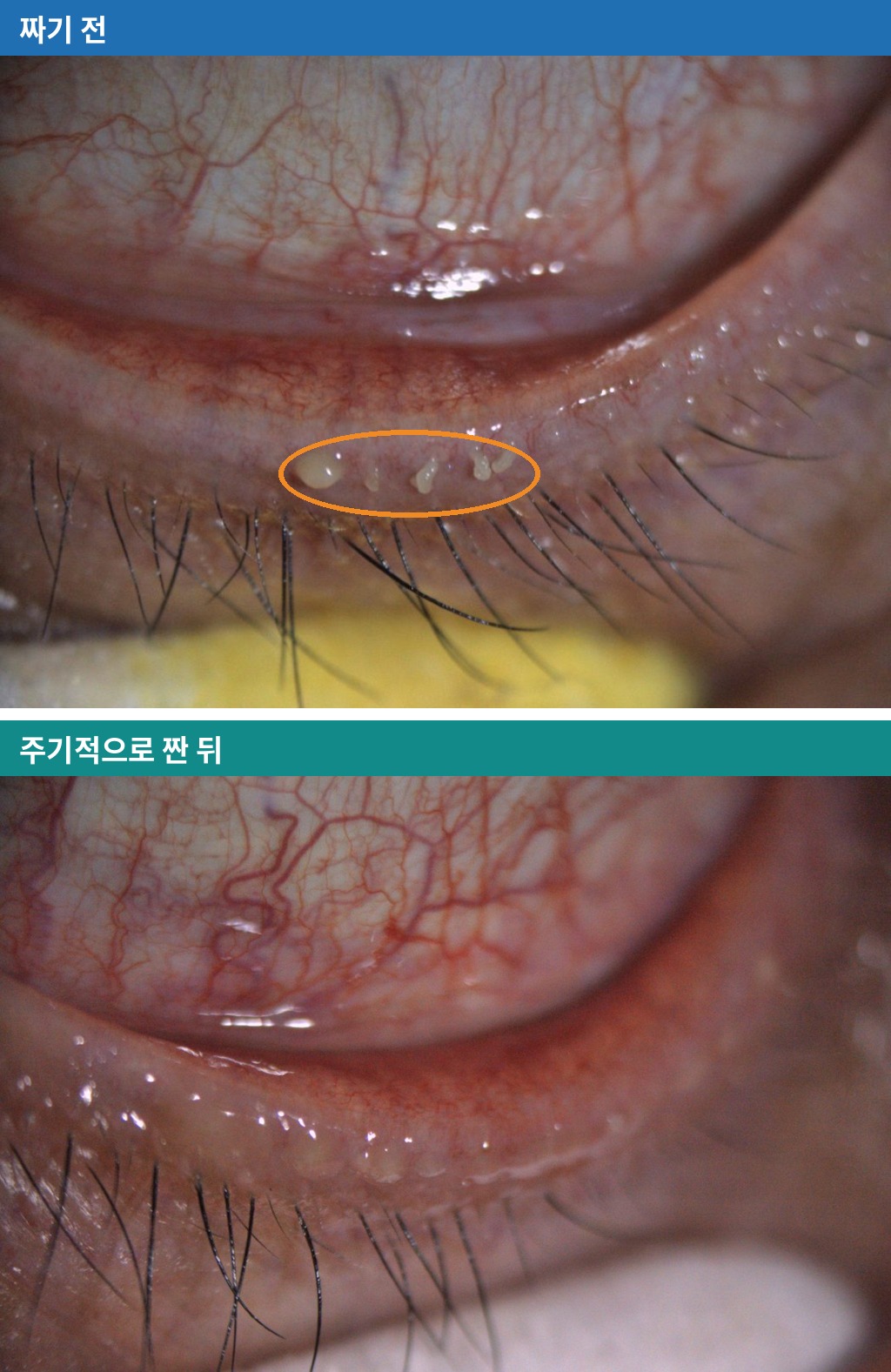 마이봄샘기능장애 짜기 전과 주기적으로 짠 뒤 눈꺼풀 비교 사진