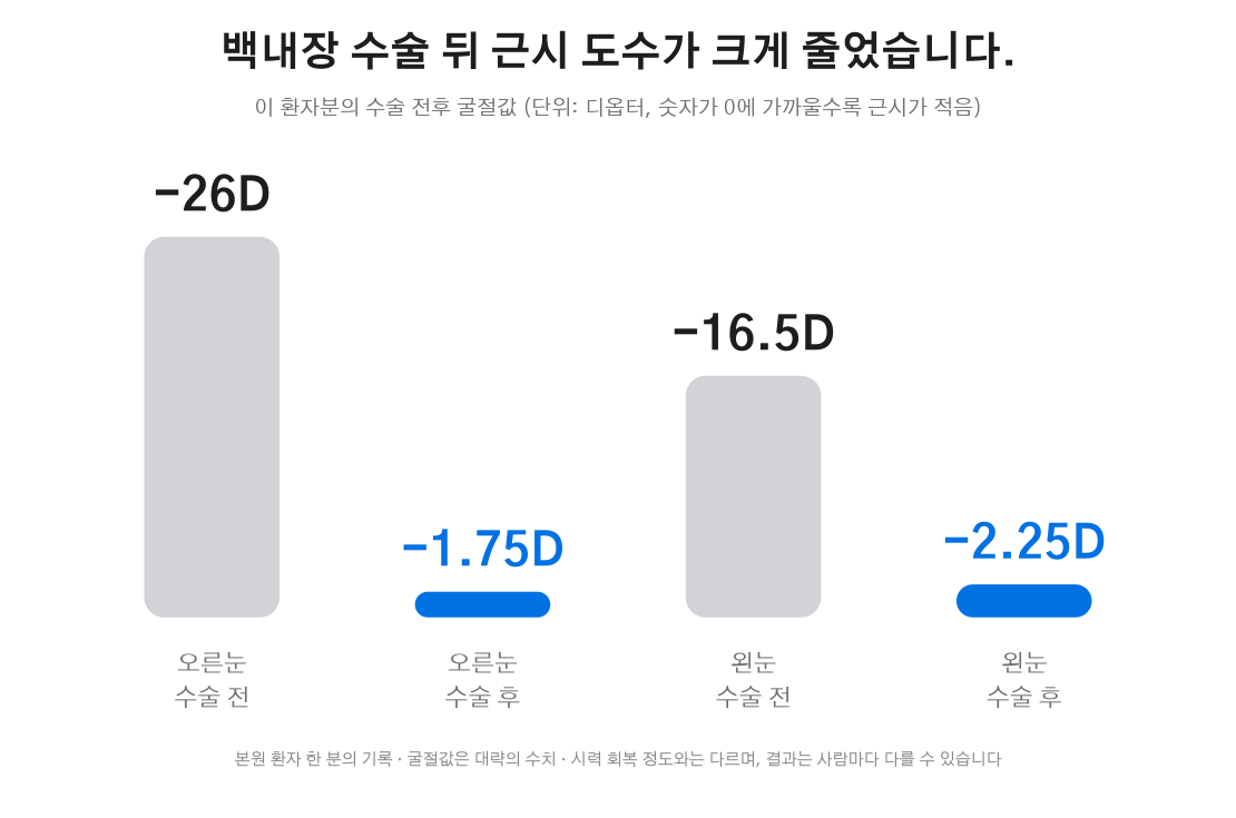 환자 한 분의 백내장 수술 전후 굴절값 그래프
