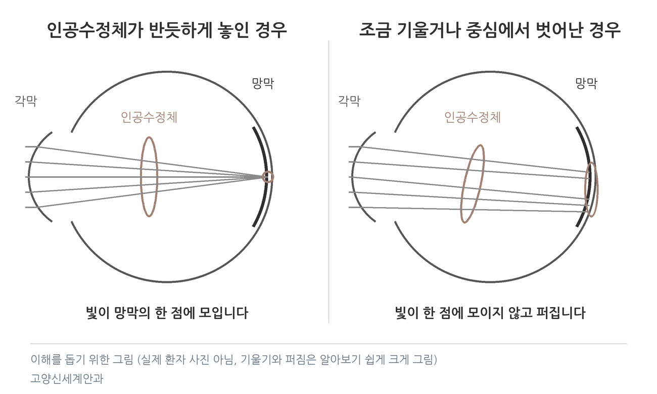 인공수정체가 반듯한 경우와 기울거나 중심에서 벗어난 경우 빛이 모이는 모습 설명 그림