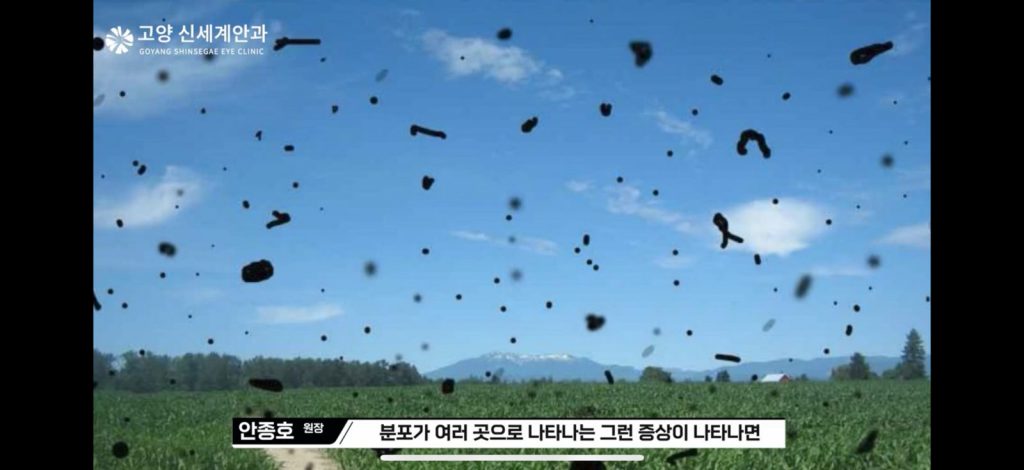 비문증 예시 — 갑자기 늘어난 날파리증이 시야에 보이는 모습 - 고양신세계안과