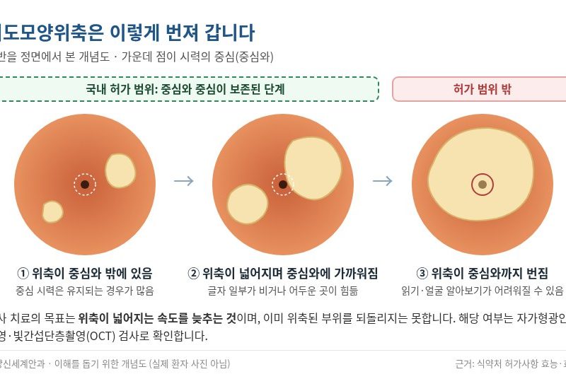 지도모양위축 진행 개념도 - 황반의 위축 부위가 중심와 쪽으로 넓어지는 과정과 국내 허가 범위 - 고양신세계안과