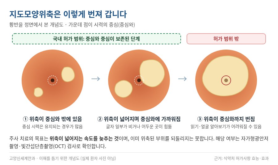 지도모양위축 진행 개념도 - 황반의 위축 부위가 중심와 쪽으로 넓어지는 과정과 국내 허가 범위 - 고양신세계안과