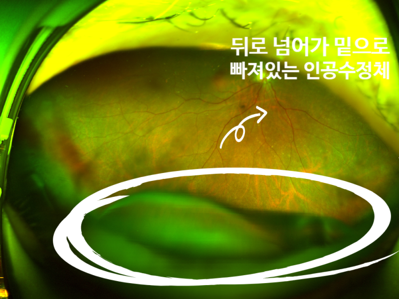 인공수정체 탈구 광각 안저 사진 - 제자리를 벗어난 인공수정체가 눈 뒤쪽 바닥에 떨어져 있는 모습