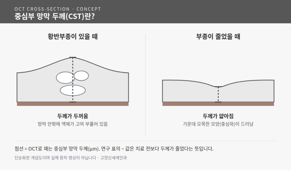 황반부종이 있을 때와 줄었을 때의 OCT 단면 개념도 - 중심부 망막 두께(CST) 비교 - 고양신세계안과