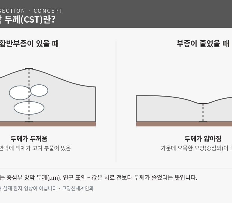 황반부종이 있을 때와 줄었을 때의 OCT 단면 개념도 - 중심부 망막 두께(CST) 비교 - 고양신세계안과