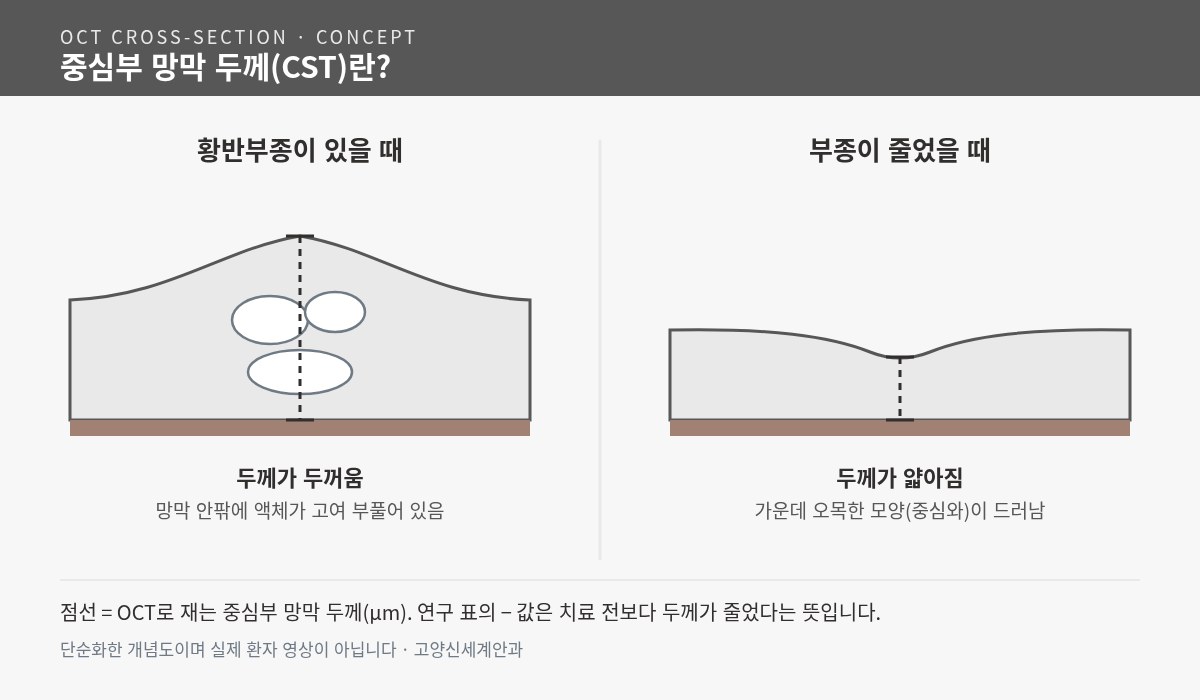 황반부종이 있을 때와 줄었을 때의 OCT 단면 개념도 - 중심부 망막 두께(CST) 비교 - 고양신세계안과