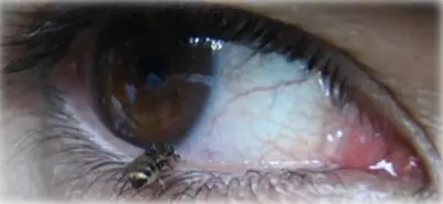 눈가에 앉은 초파리류 Phortica variegata