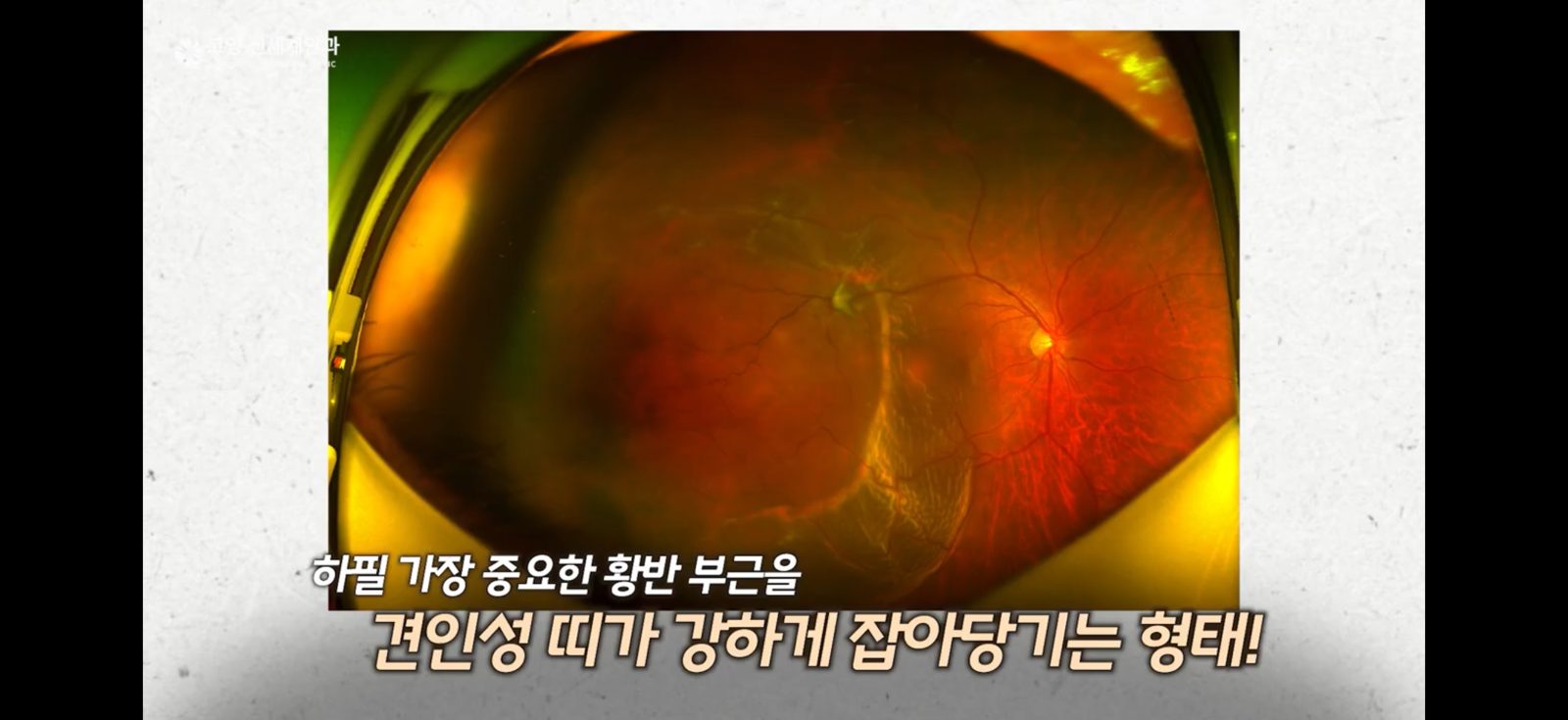 망막박리 광역안저사진 - 견인성 띠가 황반 부위를 잡아당기는 형태 - 고양신세계안과