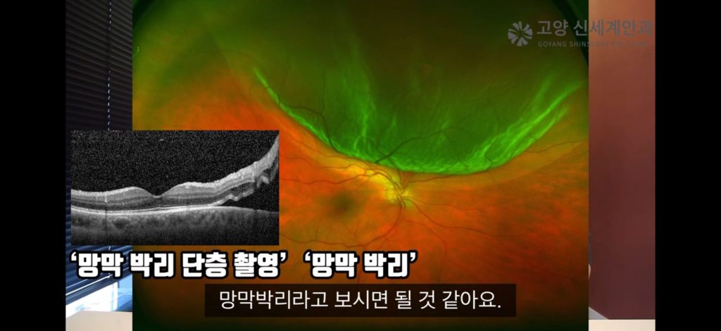 망막박리 광역안저사진과 빛간섭단층촬영(OCT) - 고양신세계안과