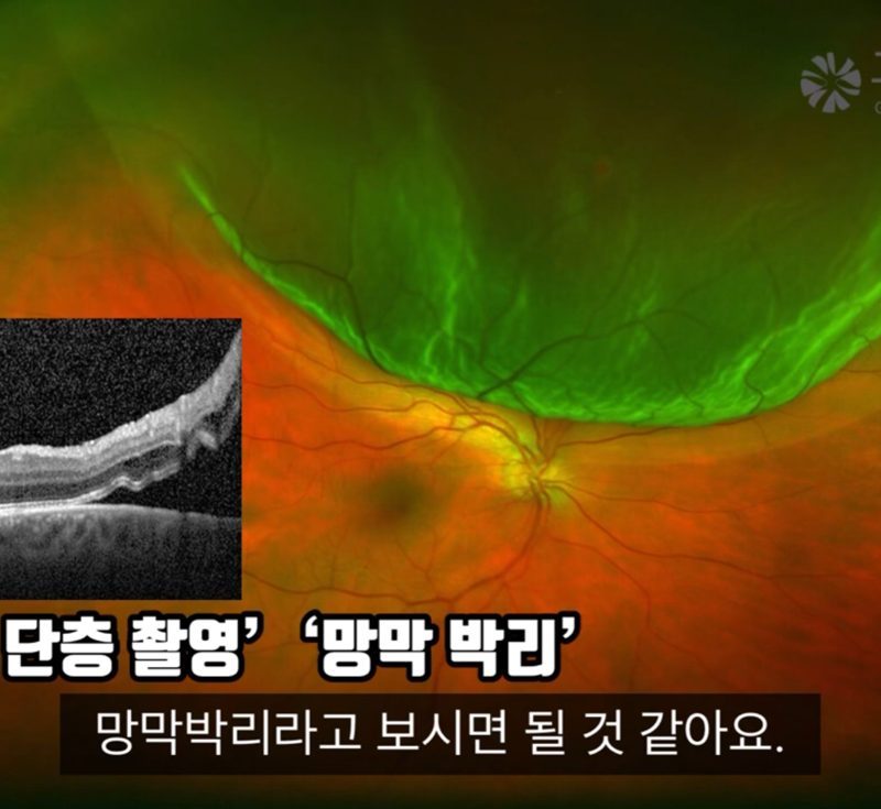 망막박리 광역안저사진과 빛간섭단층촬영(OCT) - 고양신세계안과