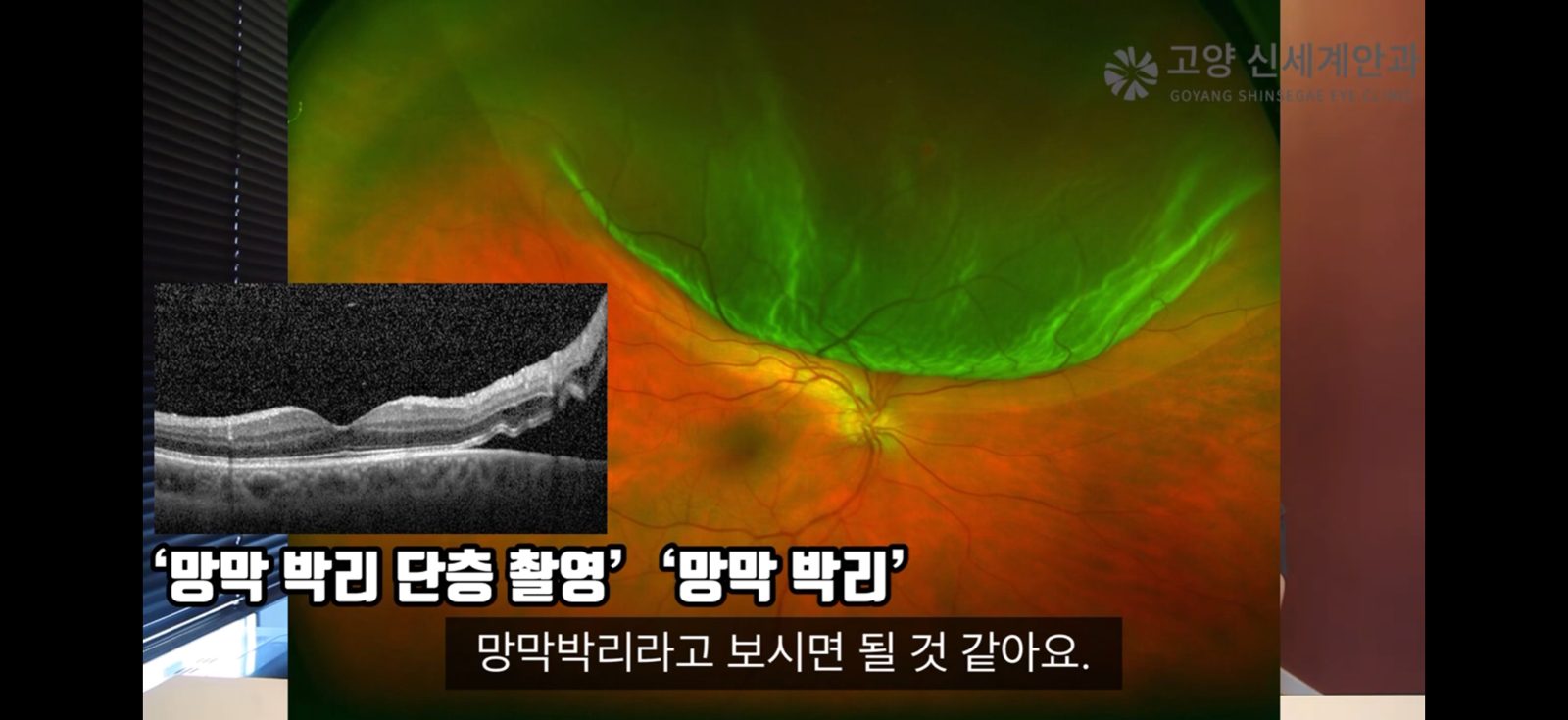 망막박리 광역안저사진과 빛간섭단층촬영(OCT) - 위쪽 망막이 떨어져 들뜬 모습 - 고양신세계안과