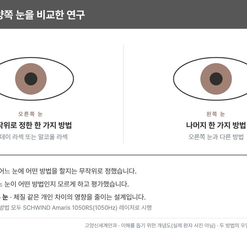 투데이 라섹 대측안 무작위 연구 설계 개념도 - 한 사람의 오른쪽 눈과 왼쪽 눈에 투데이 라섹과 알코올 라섹을 무작위로 하나씩 시행 - 고양신세계안과