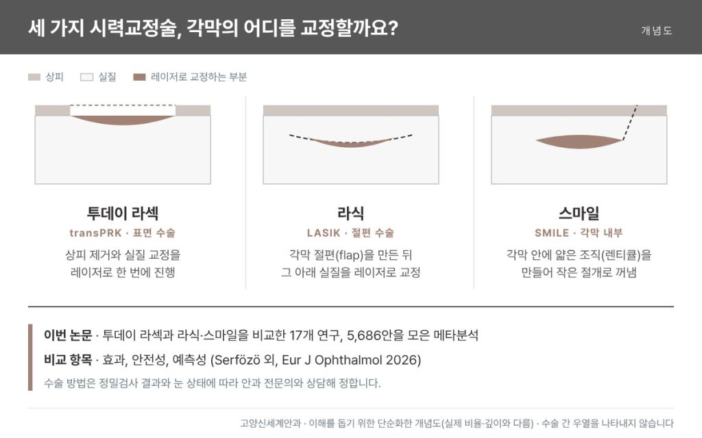 투데이 라섹·라식·스마일 교정 부위 개념도 - 표면, 절편 아래, 각막 내부 - 고양신세계안과