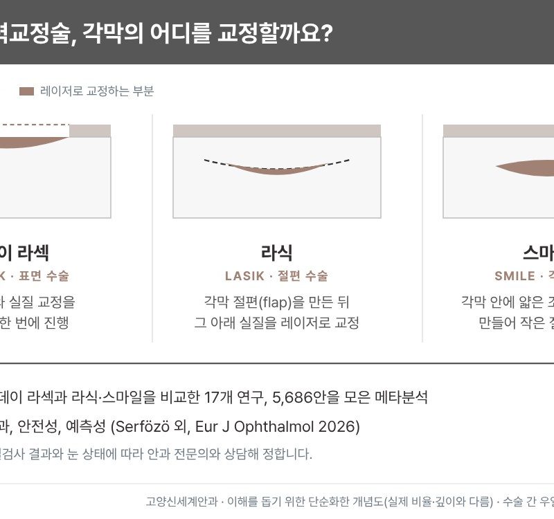 투데이 라섹·라식·스마일 교정 부위 개념도 - 표면, 절편 아래, 각막 내부 - 고양신세계안과