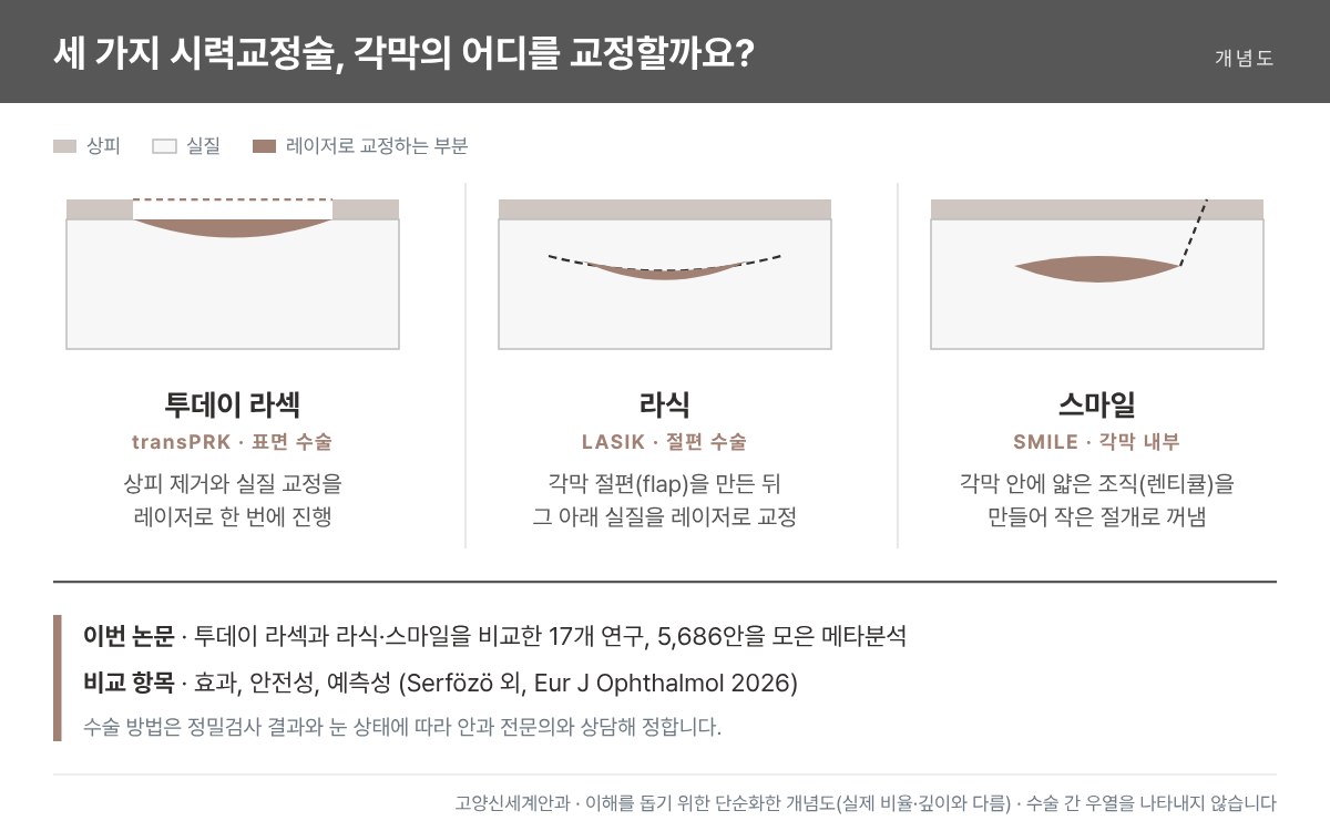 투데이 라섹·라식·스마일 교정 부위 개념도 - 표면, 절편 아래, 각막 내부 - 고양신세계안과