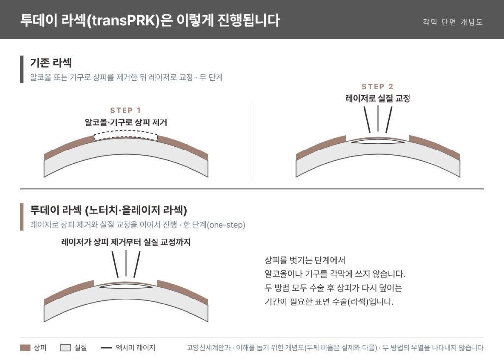 투데이 라섹(transPRK) 개념도 - 기존 라섹은 알코올·기구로 상피를 제거한 뒤 레이저로 교정하고, 투데이 라섹은 레이저로 상피 제거와 실질 교정을 한 번에 진행 - 고양신세계안과