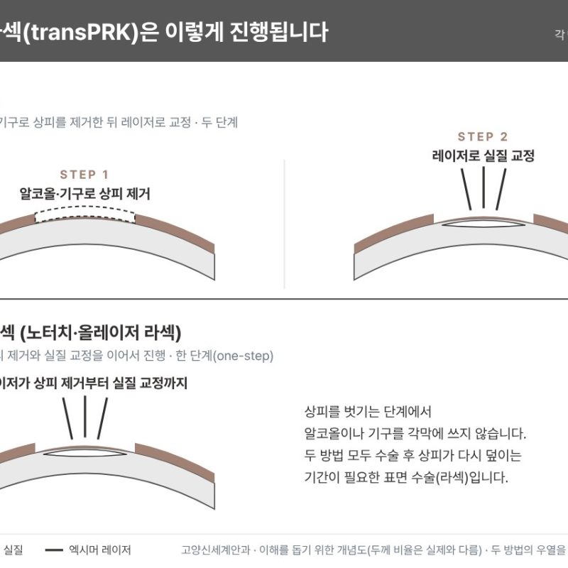 투데이 라섹(transPRK) 개념도 - 기존 라섹은 알코올·기구로 상피를 제거한 뒤 레이저로 교정하고, 투데이 라섹은 레이저로 상피 제거와 실질 교정을 한 번에 진행 - 고양신세계안과