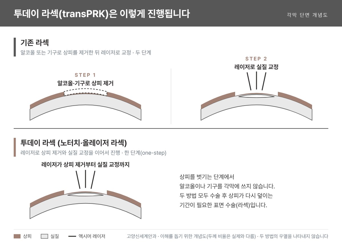 투데이 라섹(transPRK) 개념도 - 기존 라섹은 알코올·기구로 상피를 제거한 뒤 레이저로 교정하고, 투데이 라섹은 레이저로 상피 제거와 실질 교정을 한 번에 진행 - 고양신세계안과