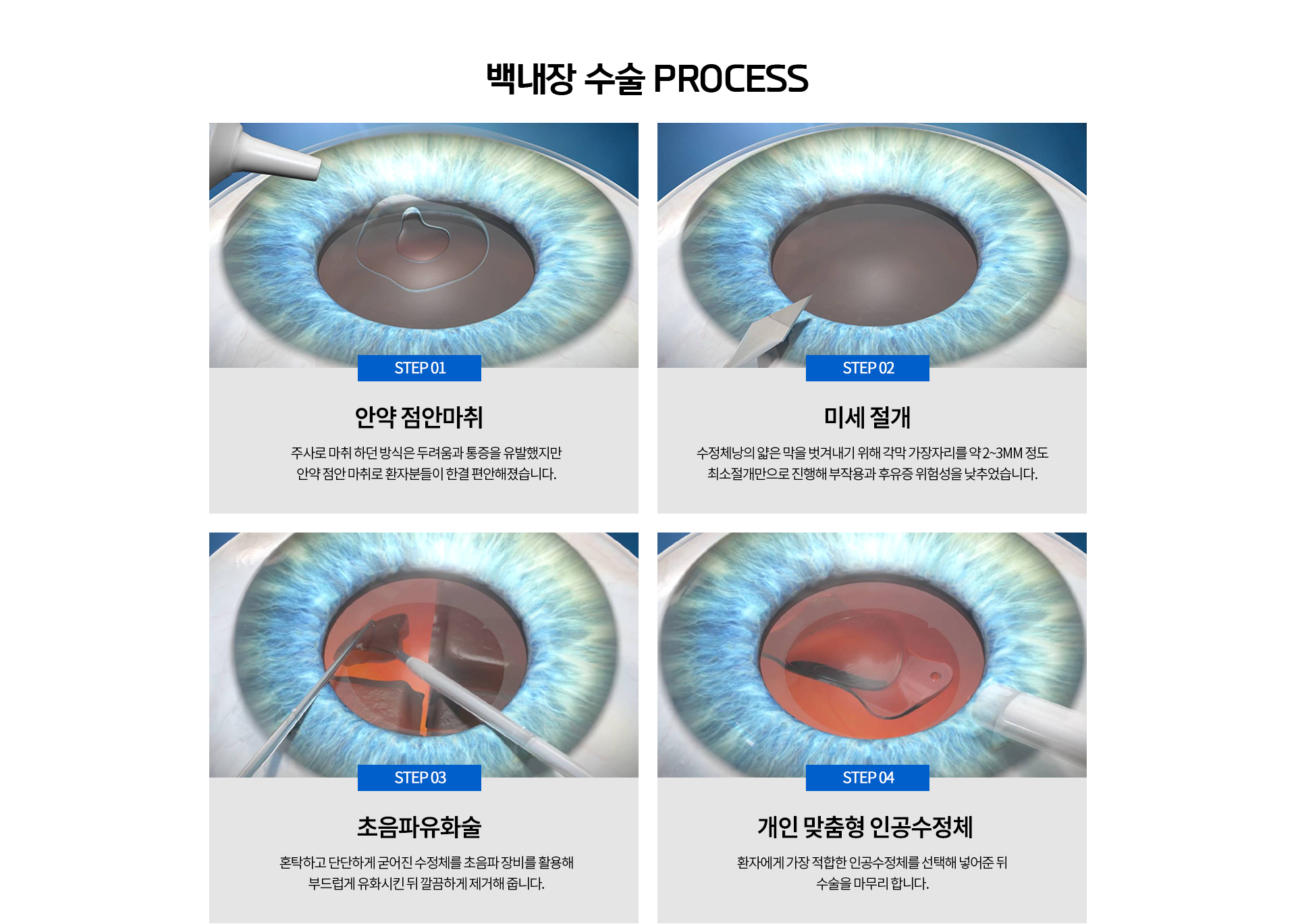 안약 점안마취, 미세절개, 초음파유화술, 개인맞춤형 인공수정체   