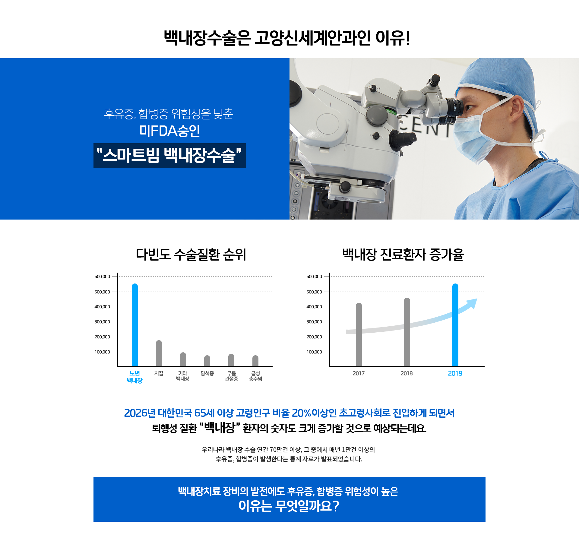 스마트빔 백내장수술