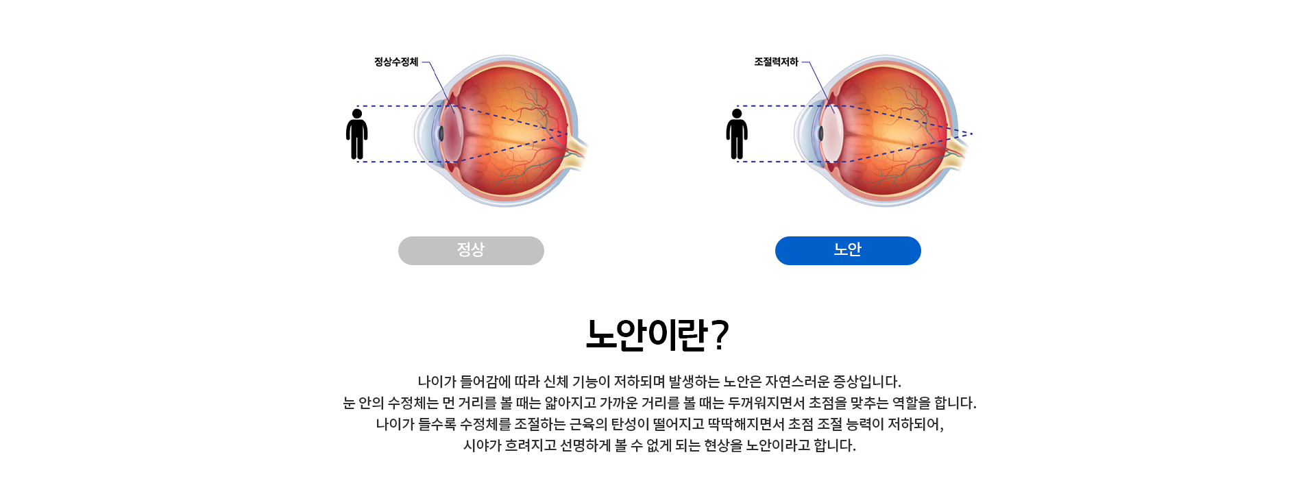 나이들어감에 따라 신체 기능이 저하되며 발생하는 노안은 자연스러운 증상입니다. 시야가 흐려지고 선명하게 볼 수 없게 되는 것을 노안이라고 합니다.