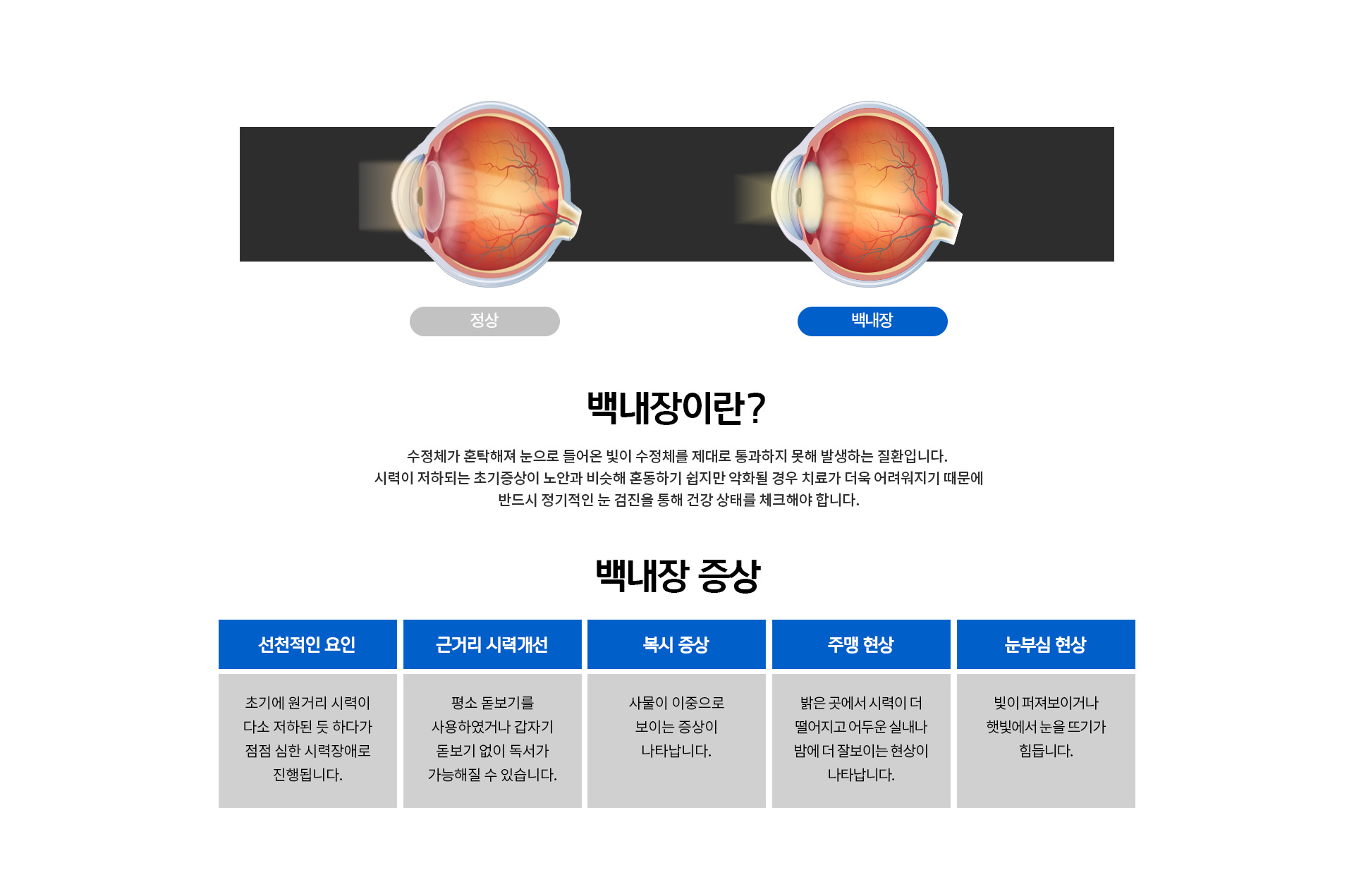 백내장 증상, 선천적 요인, 근거리 시력개선, 복시 증상, 주맹현상, 눈부심현상