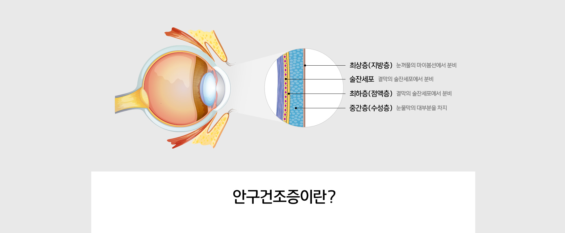 안구건조증이란? 눈물 수분 부족형 15%. 눈물 증발 과다형 80%