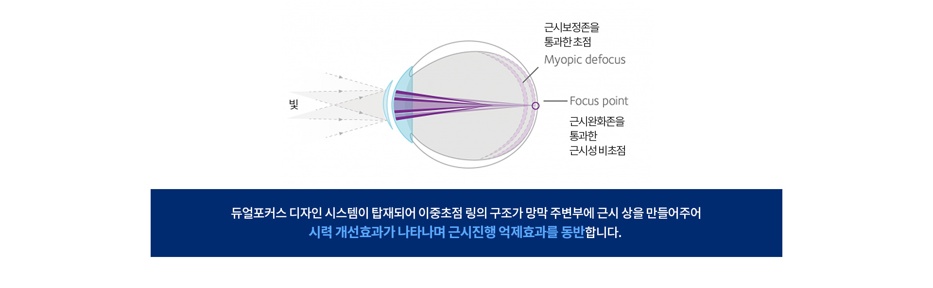 듀얼포커스 디자인 시스템이 탑재되어 이중초점 링의 구조가 망막 주변부에 근시 상을 만들어 주어 시력 개선효과가 나타나며 근시진행 억제 효과를 동반합니다.