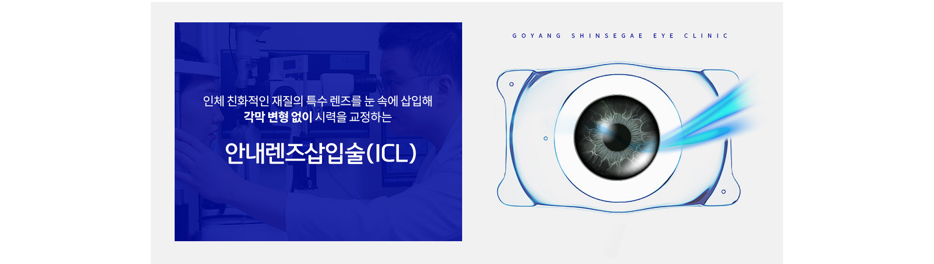 안내렌즈삽입술(ICL)