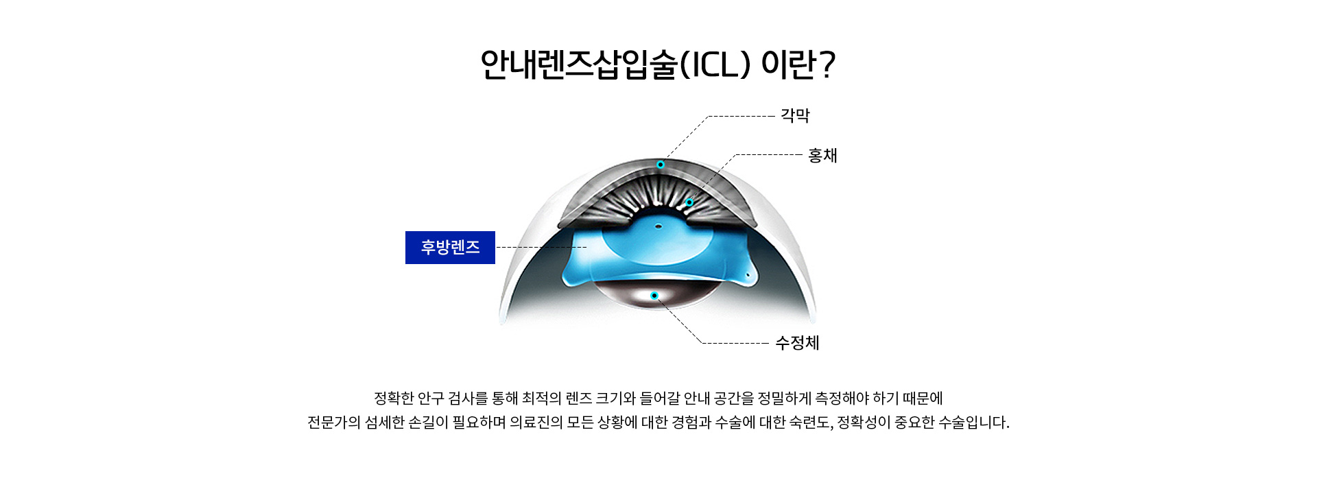 정확한 안구 검사를 통해 최적의 렌즈 크기와 들어갈 안내 공간을 정밀하게 측정해야 하기 때문에 전문의의 섬세한 손길이 필요하며 정확성이 중요한 수술입니다. 