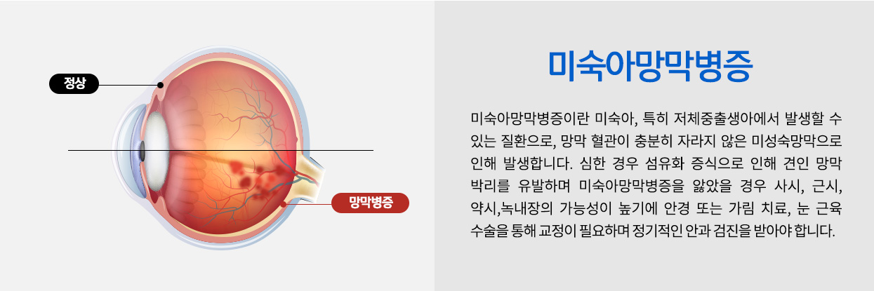 미숙아망막병증