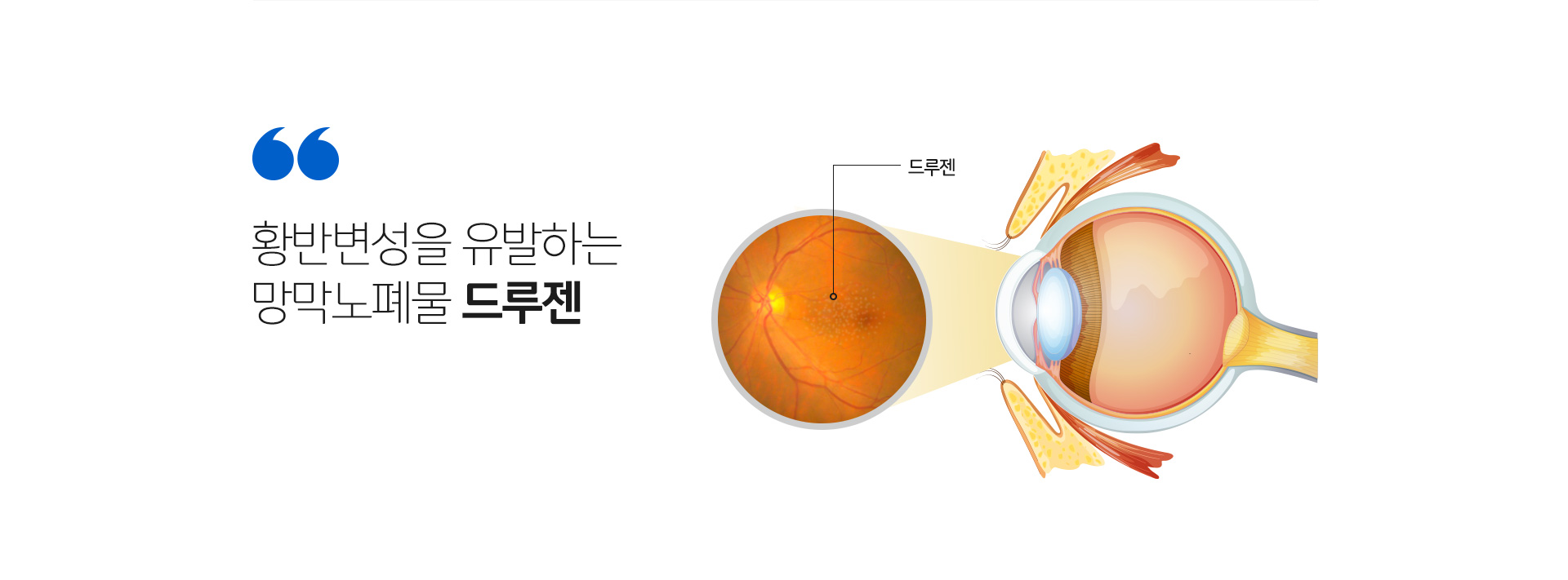 황반변성을 유발하는 망막노폐물 드루젠