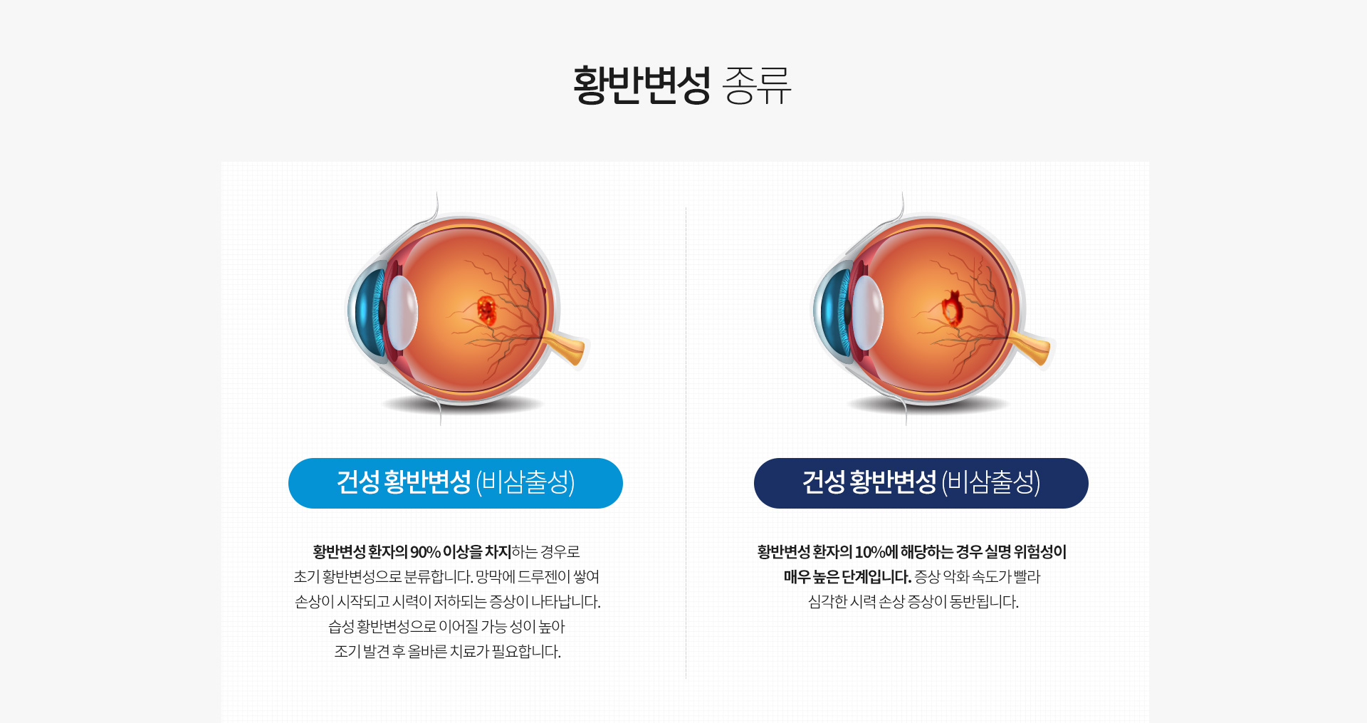 황반변성종류, 건성 황반변성(비삼출성), 건정 황반변성(비삼출성)