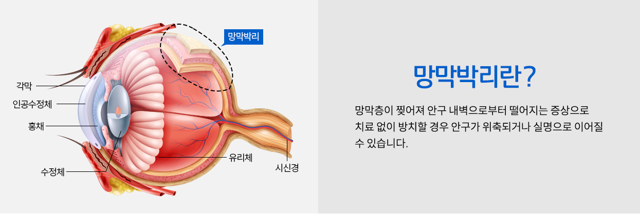 망막박리