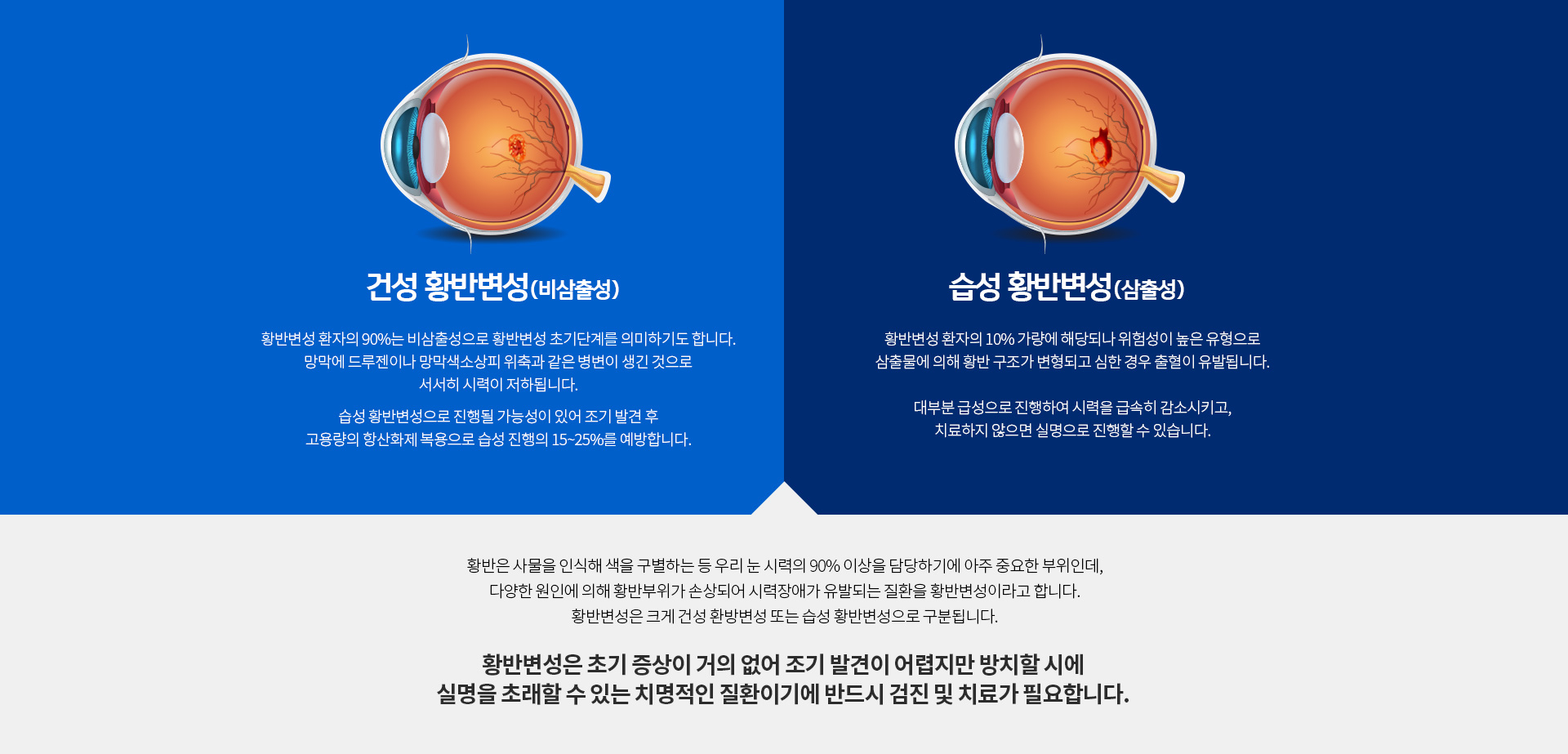 건성 환반변성(비삼출성), 습성 황반변성(삼출성)