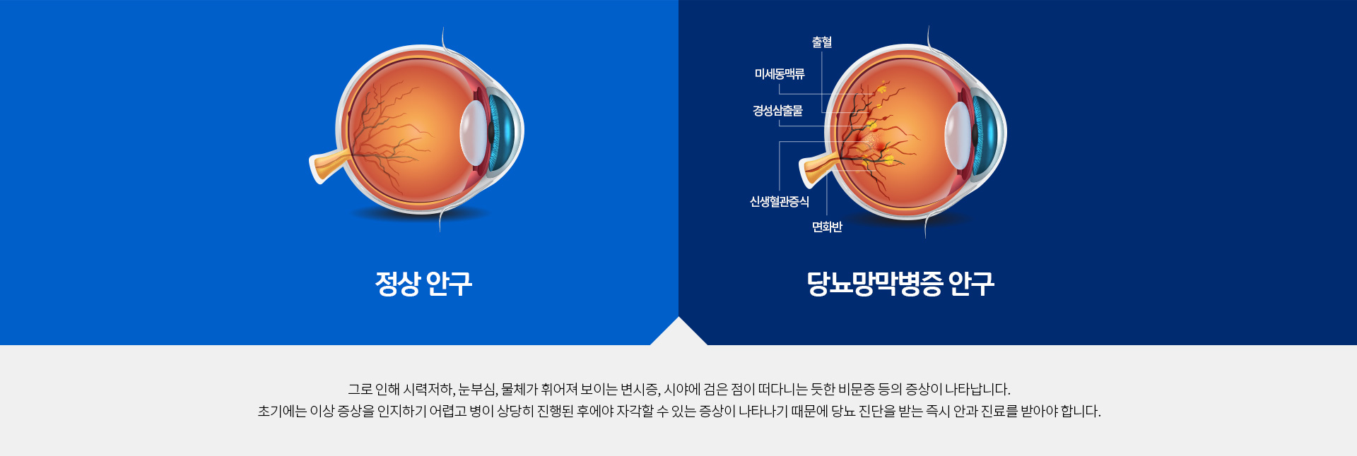 시력저하, 눈부심, 변시증, 비문증 등의 증상이 나타납니다. 당뇨 진단을 받는 즉시 안과 진료를 받아야 합니다.