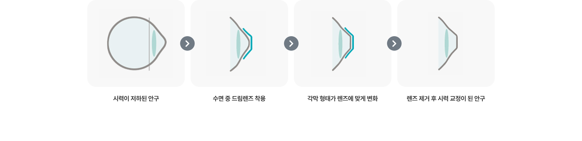 시력이 저하된 안구 → 수면 중 드림렌즈 착용 → 각막 형태가 렌즈에 맞게 변화 → 렌즈 제거 후 시력 교정이 된 안구