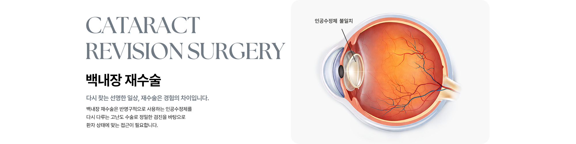 [백내장 재수술 : 다시 찾는 선명한 일상, 재수술은 경험의 차이입니다.] 백내장 재수술은 반영구적으로 사용하는 인공수정체를 다시 다루는 고난도 수술로 정밀한 검진을 바탕으로 환자 상태에 맞는 접근이 필요합니다.