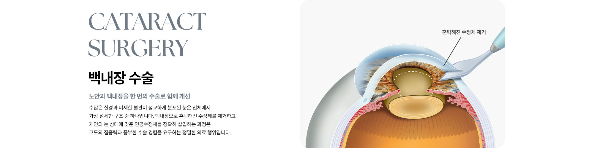 [백내장 수술 : 노안과 백내장을 한 번의 수술로 함께 개선] 백내장 수술은 백내장으로 혼탁해진 수정체를 제거하고 개인의 눈 상태에 맞춘 인공수정체를 정확히 삽입하는 고도의 집중력과 풍부한 수술 경험을 요구하는 정밀한 의료 행위를 말합니다.