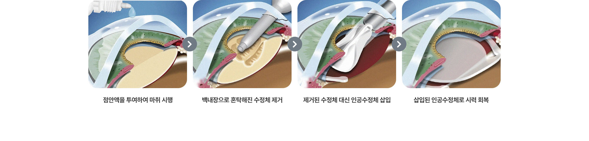(1) 점안액을 투여하여 마취 시행 (2) 백내장으로 혼탁해진 수정체 제거 (3) 제거된 수정체 대신 인공수정체 삽입 (4) 삽입된 인공수정체로 시력 회복