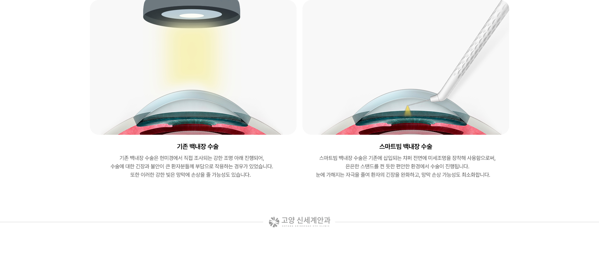 {기존 백내장 수술} 현미경에서 직접 조사되는 강한 조명 아래 진행되어 수술에 대한 긴장과 불안이 큰 환자분들께 부담으로 작용하는 경우가 있으며, 이러한 강한 빛은 망막에 손상을 줄 가능성도 있습니다. / {스마트빔 백내장 수술} 기존에 삽입되는 챠퍼 전면에 미세조명을 장착해 사용함으로써, 은은한 스탠드를 켠 듯한 편안한 환경에서 수술이 진행되어 눈에 가해지는 자극을 줄여 환자의 긴장을 완화하고, 망막 손상 가능성도 최소화합니다.