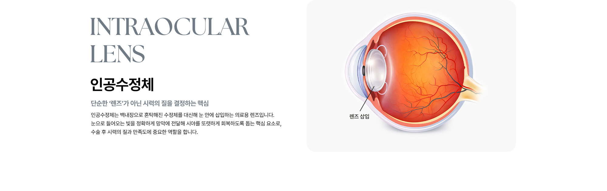 [인공수정체 : 단순한 ‘렌즈’가 아닌 시력의 질을 결정하는 핵심] 인공수정체는 백내장으로 혼탁해진 수정체를 대신해 눈 안에 삽입하는 의료용 렌즈로 수술 후 시력의 질과 만족도에 중요한 역할을 합니다.