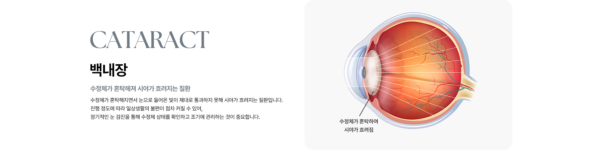 [백내장 : 수정체가 혼탁해져 시야가 흐려지는 질환] 수정체가 혼탁해지면서 시야가 흐려지는 질환이며 진행 정도에 따라 일상생활의 불편이 점차 커질 수 있어, 정기적인 검진을 통해 조기에 관리하는 것이 중요합니다.