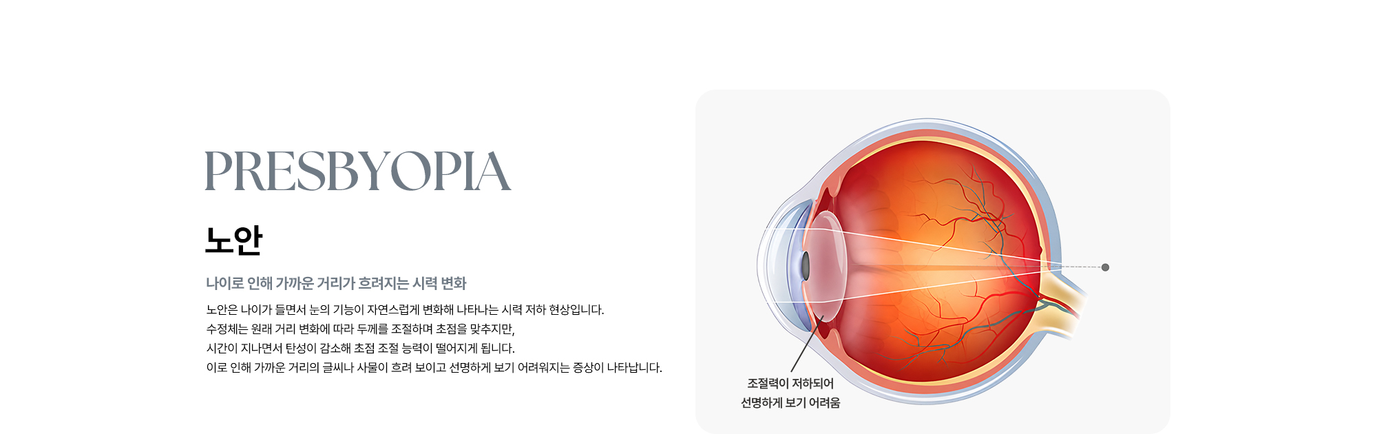 [노안 : 나이로 인해 근거리가 흐려지는 시력 변화] 노안은 나이가 들면서 수정체의 탄성이 감소해 초점 조절 능력이 떨어져 나타나는 시력 저하 현상입니다. 이로 인해 근거리의 글씨나 사물이 흐려 보이는 증상이 나타납니다.