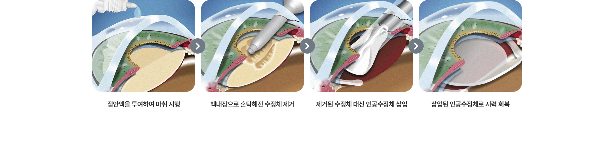 {백내장 수술 순서} (1) 점안액을 투여하여 마취 시행 (2) 백내장으로 혼탁해진 수정체 제거 (3) 제거된 수정체 대신 인공수정체 삽입 (4) 삽입된 인공수정체로 시력 회복