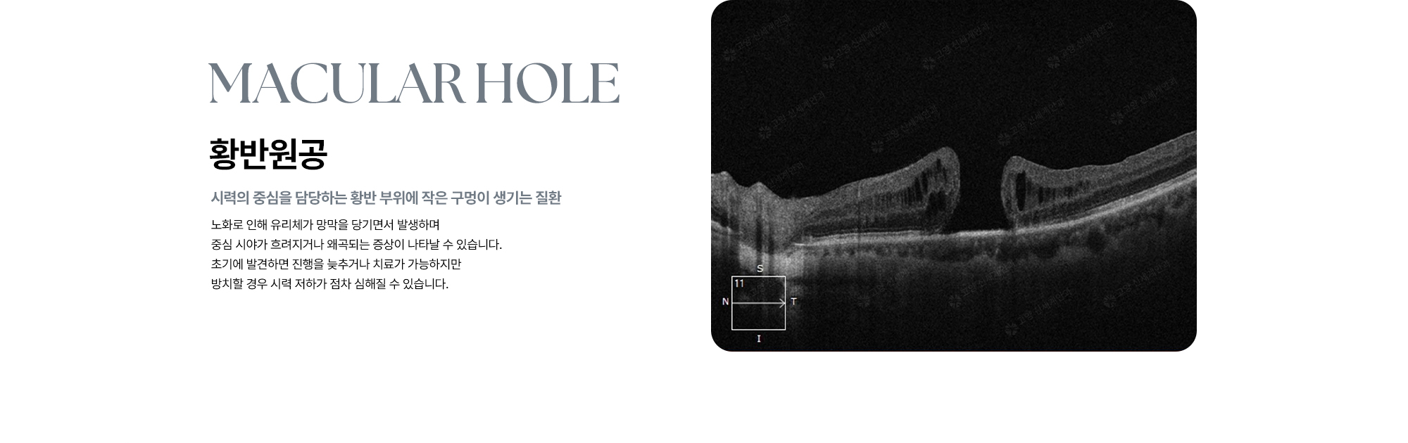 [황반원공 : 시력의 중심을 담당하는 황반 부위에 작은 구멍이 생기는 질환] 노화로 인해 유리체가 망막을 당기면서 발생하며 중심 시야가 흐려지거나 왜곡되는 증상이 나타날 수 있습니다.