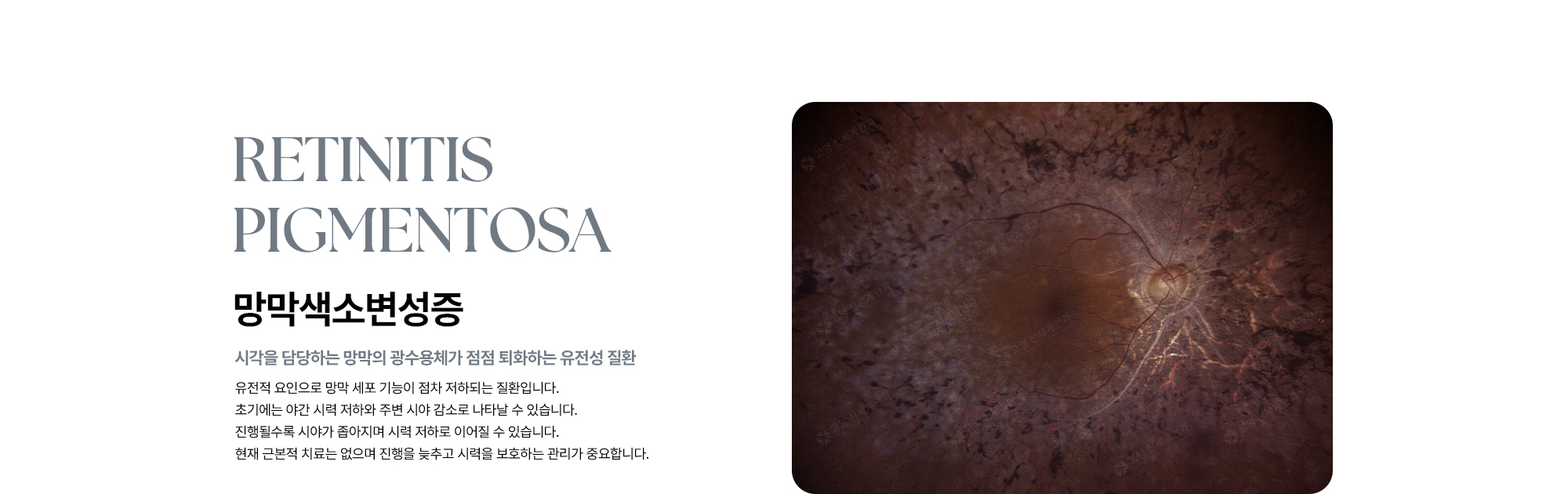 [망막색소변성증 : 시각을 담당하는 망막의 광수용체가 점점 퇴화하는 유전성 질환] 유전적 요인으로 망막 세포 기능이 점차 저하되는 질환으로, 현재 근본적 치료가 없어 진행을 늦추고 시력을 보호하는 관리가 중요합니다.